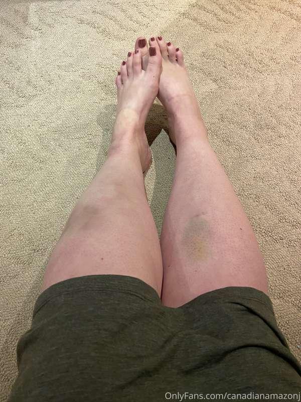 When your bruises match your dress 😋 #legs #arches #knees an..