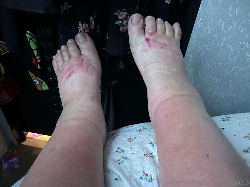 I got sunburnt and it hurts I’m pitiful!