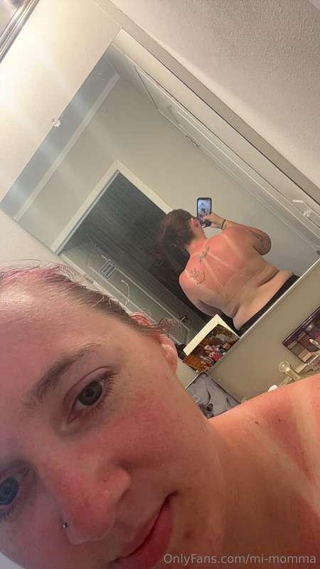 Anyone want to come rub aloe on me? 