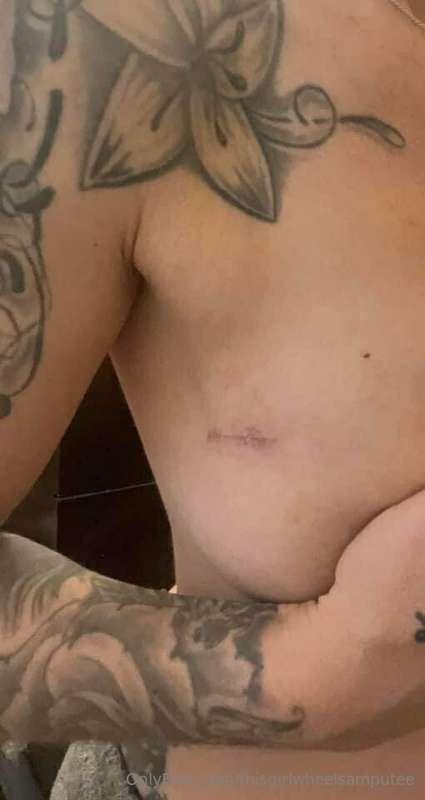 My surgery battle wounds 💪🏼🦾