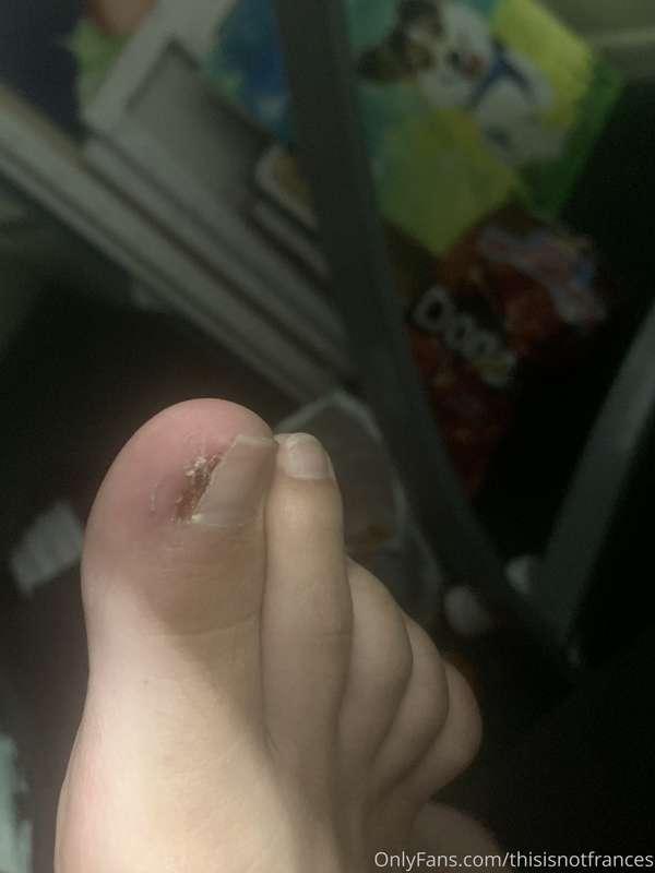 Update my foot is healing beautifully!! In about another wee..