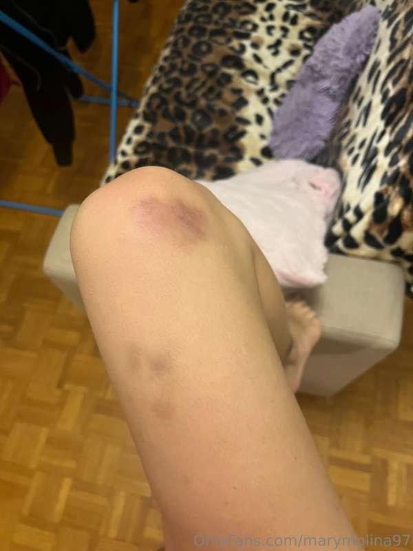 Uffa mi sono fatta male in palestra :(