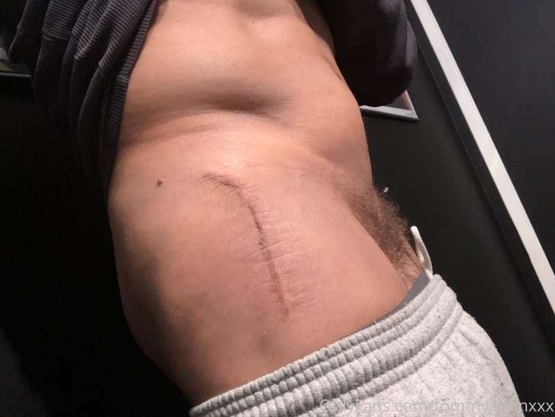 Bandages off, scars not too bad. 😊