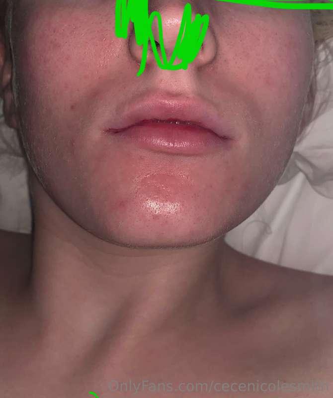 Can you guys be 100% honest with me, should I get I my lip f..