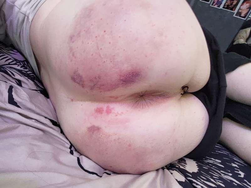 Do you enjoy seeing me covered in bruises~