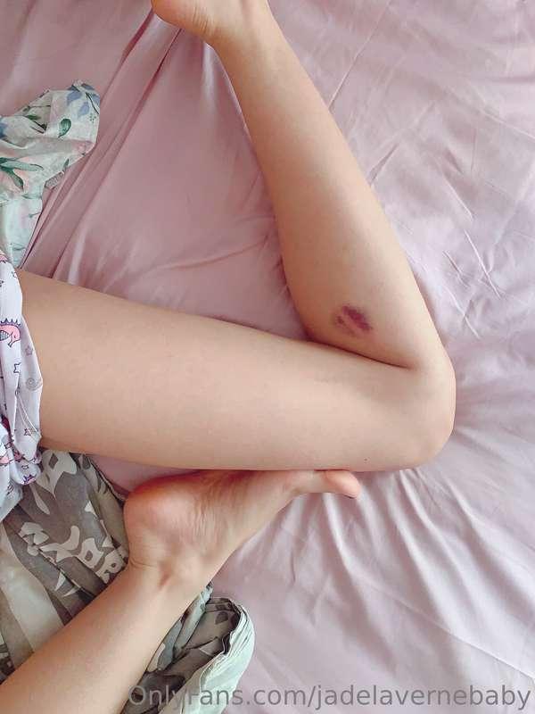 New bruise 🥺