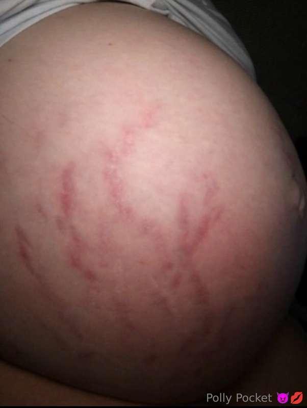 Throwback to my first pregnancy. I got bad stretch marks the..