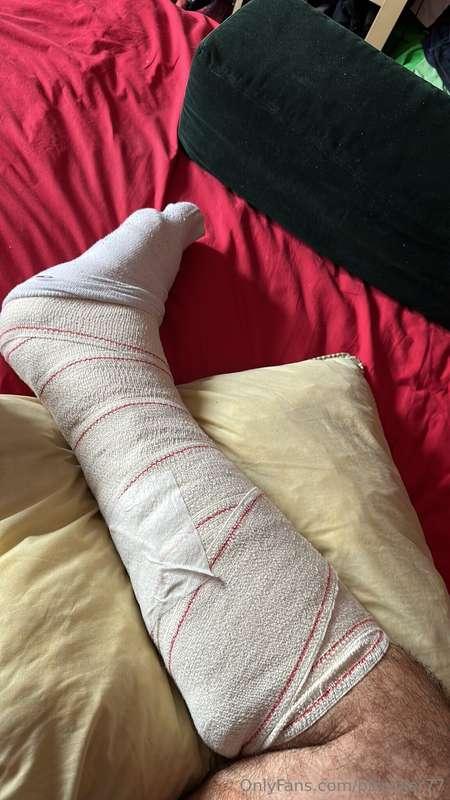 Yes, that's my leg.
Last week I fell on the stairs in the st..