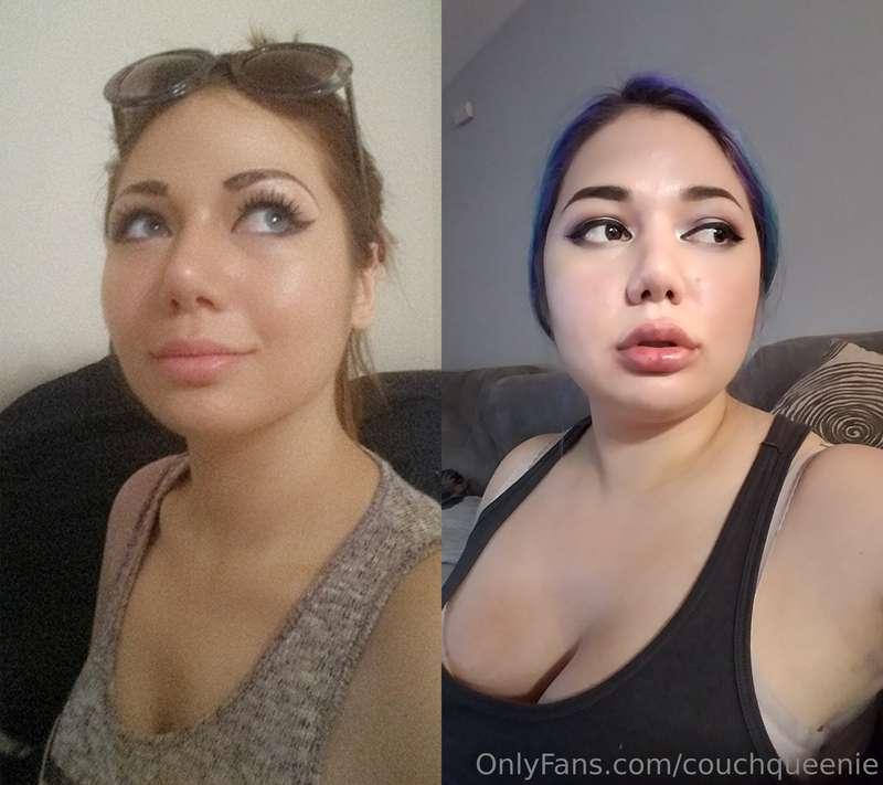 Crazy how much my face has changed.After pic is like 1 day p..