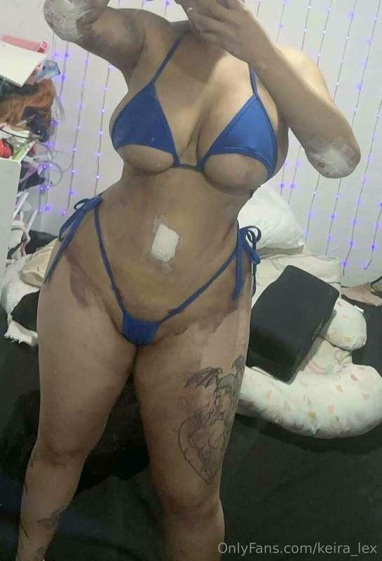 2nd day after my surgery