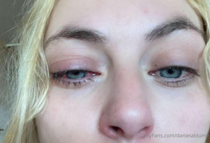Mira Como me dejó el ojo con la corrida de Ayer… 

My eye af..