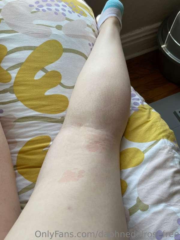 My cat stepped on me lol