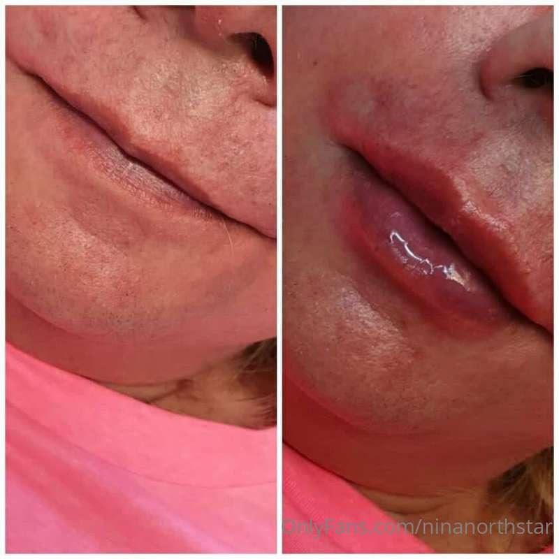 Finally got my lips filled with 1,1ml Revolax 💕