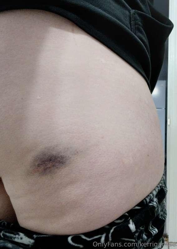 Day two bruise 😩 