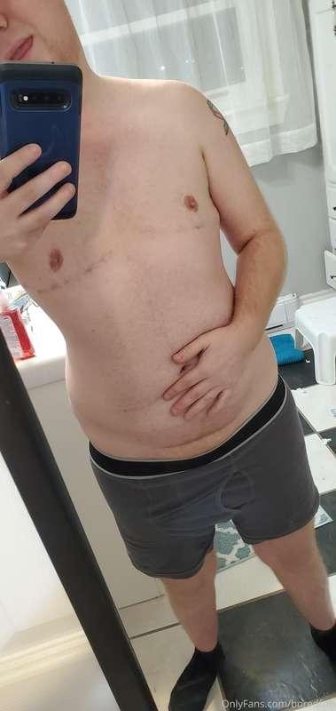 Officially 3 weeks post op. 
Looking forward to the new year..