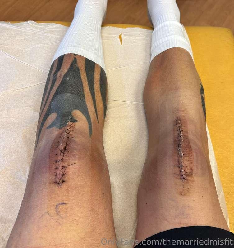 Staples and stitches removed 