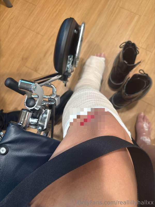 i Broke my ankle im stuck on a cast for 8 more weeks. Uber d..