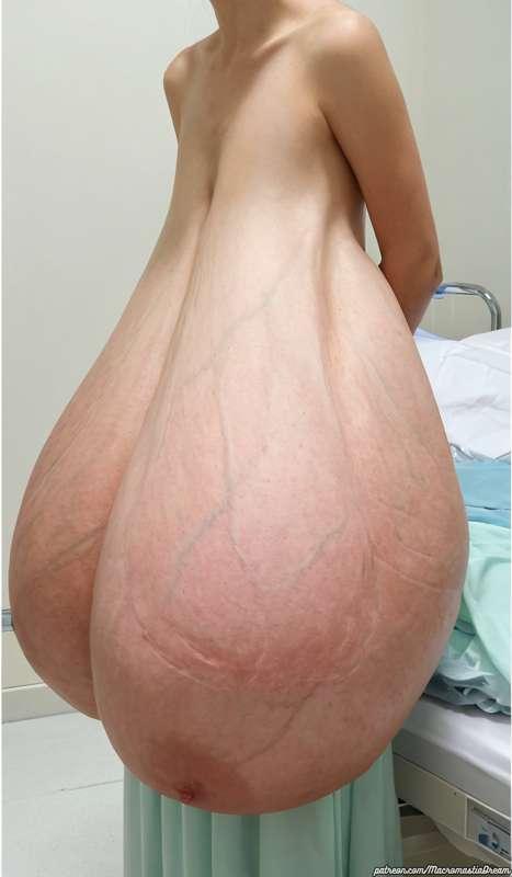 Medical Gigantomastia