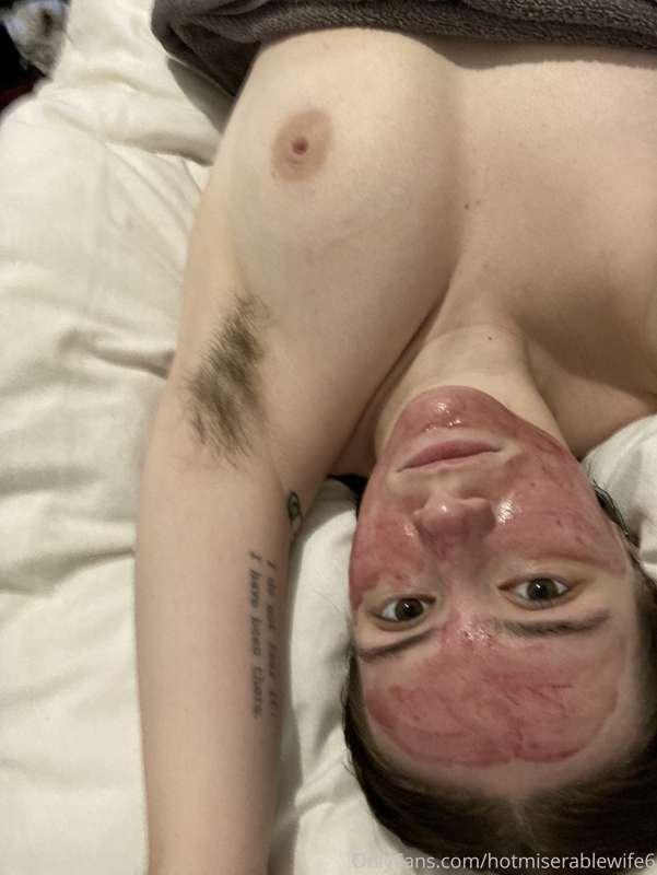 vampire facial
