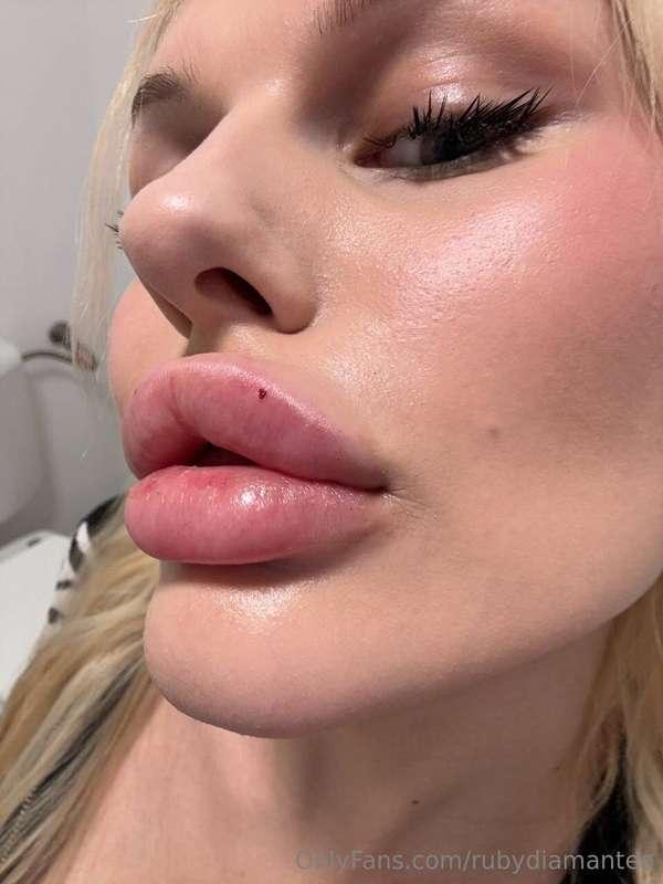 Sweet lips 🫦 I decided to add a little more volume to my lip..