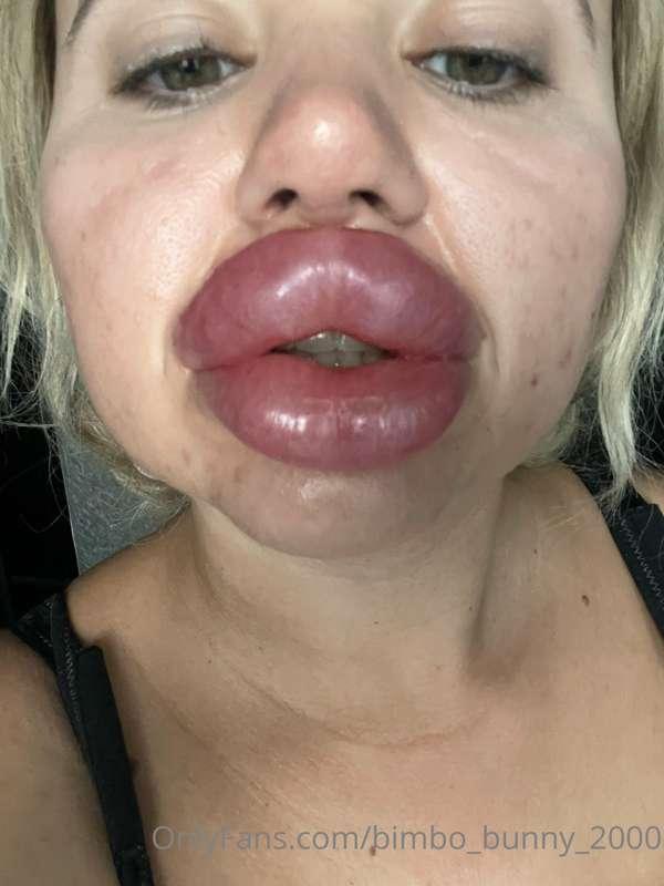 They are so swollen 💉✨