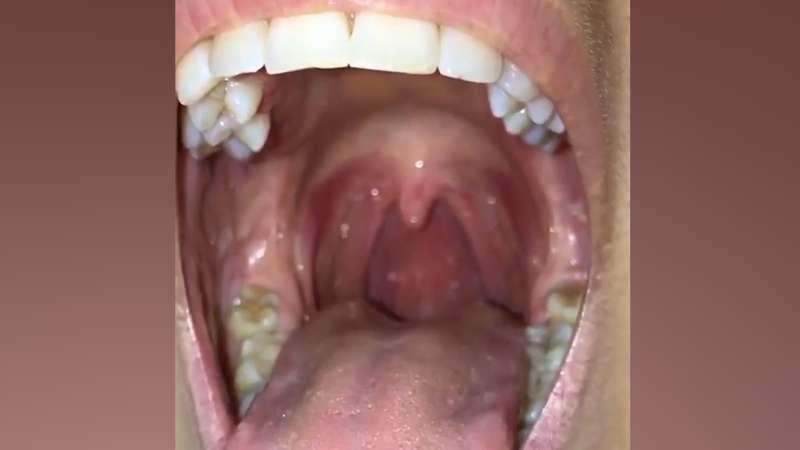 Look !!!!!!Video of girl with big uvula and wide throat.