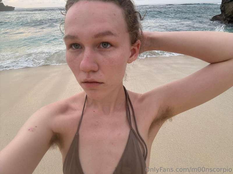 i have been sunburnt 
