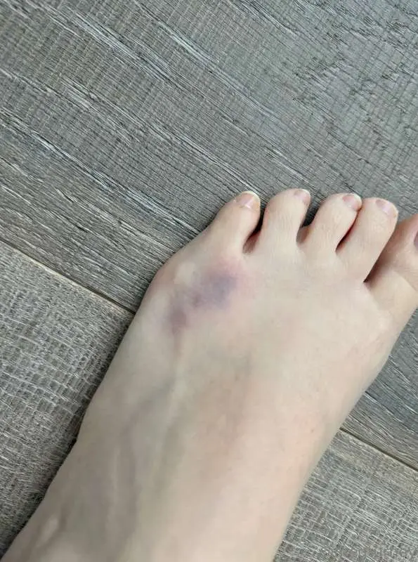 I got a hella foot owie today - kiss it and make it better??..