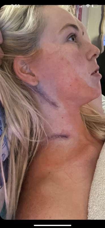 Update on skin cancer 