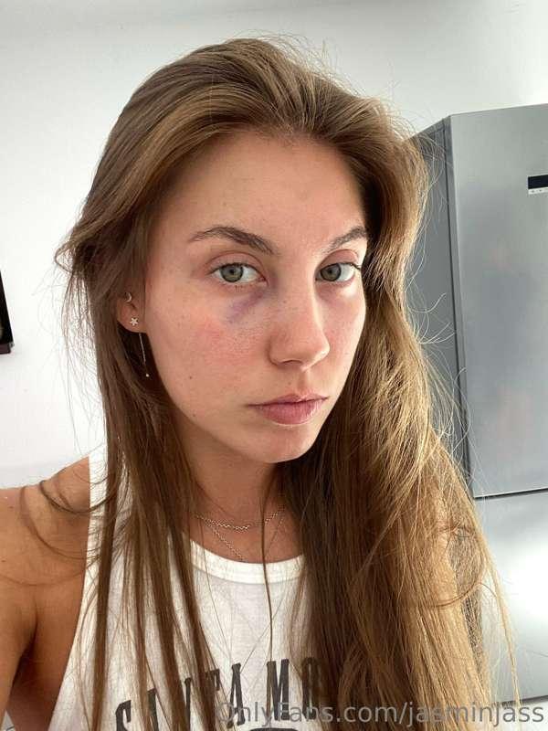 Some tips for potato on my eye?😂🥲 I am okey guys, just passe..