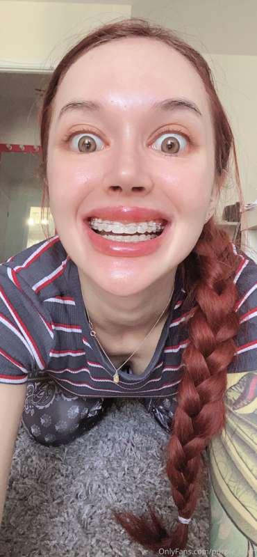 Do you like braces?😂😂😂😂😂😂
