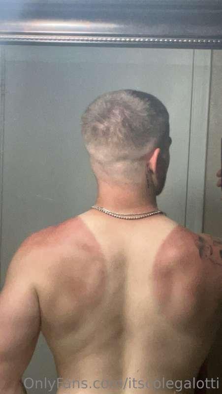 We love a good sun burn…😭