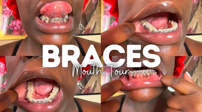 new video posted! 𝗕𝗿𝗮𝗰𝗲𝘀 🦷 𝖬𝗈𝗎𝗍𝗁 𝖳𝗈𝗎𝗋