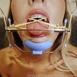 brace_faced_princess