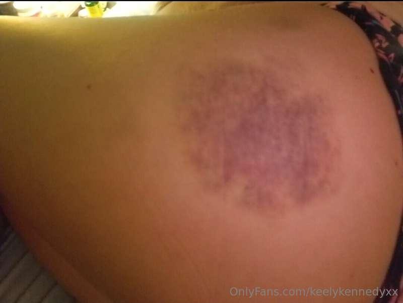 Check out this bruise I have on my ass from roller derby pra..